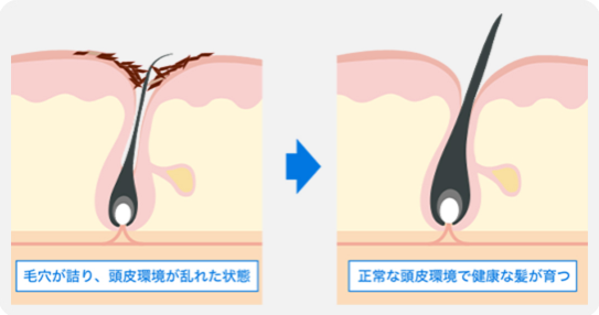 AGA注入治療：料金